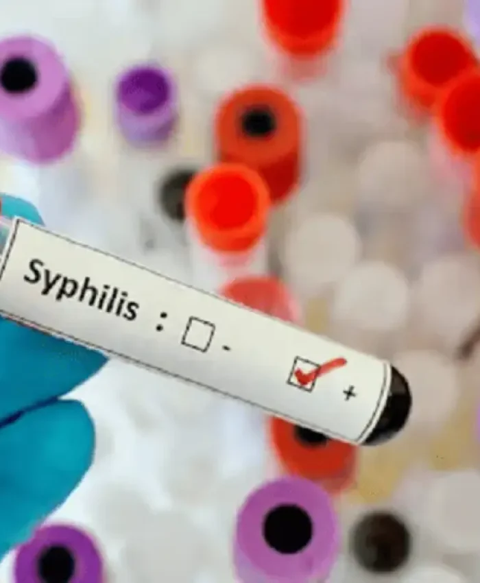 Alarmante suba de los casos de sífilis: en el ultimo año se incrementaron un 71%