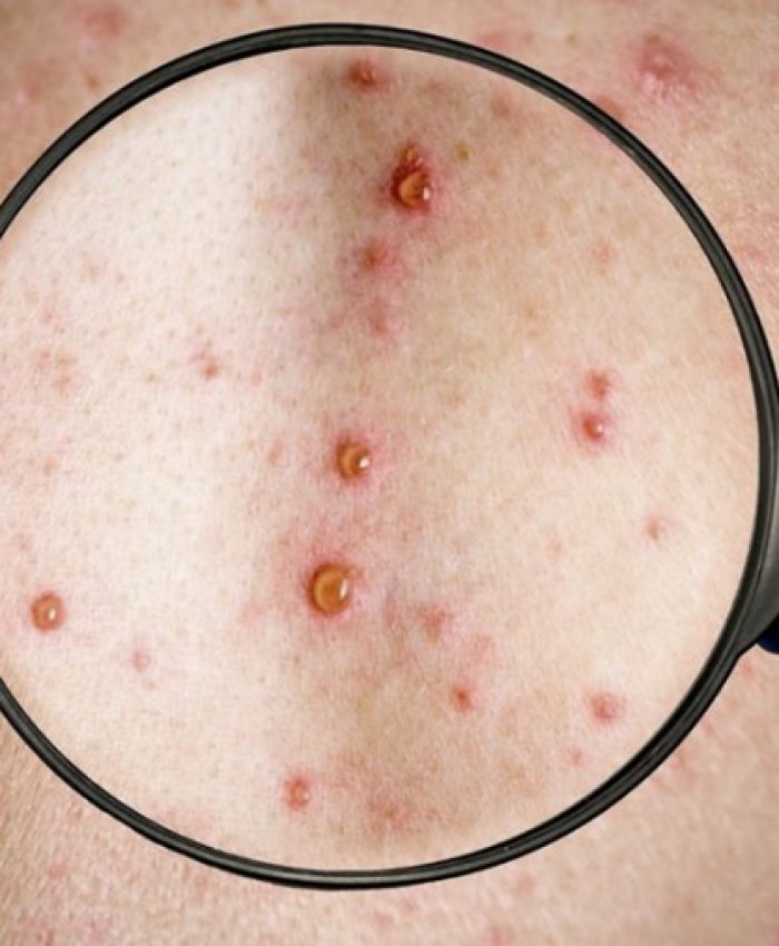 ARGENTINA: confirman el segundo caso de viruela del mono