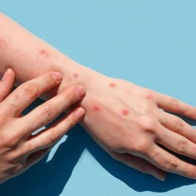 Qué es la mpox y cuáles son las medidas para prevenir la enfermedad