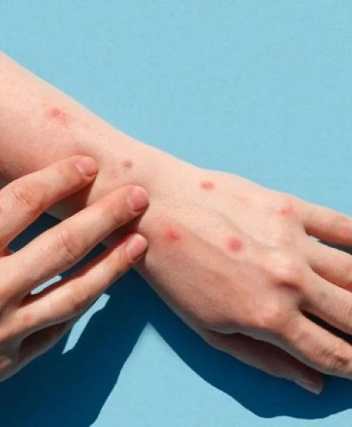 Qué es la mpox y cuáles son las medidas para prevenir la enfermedad