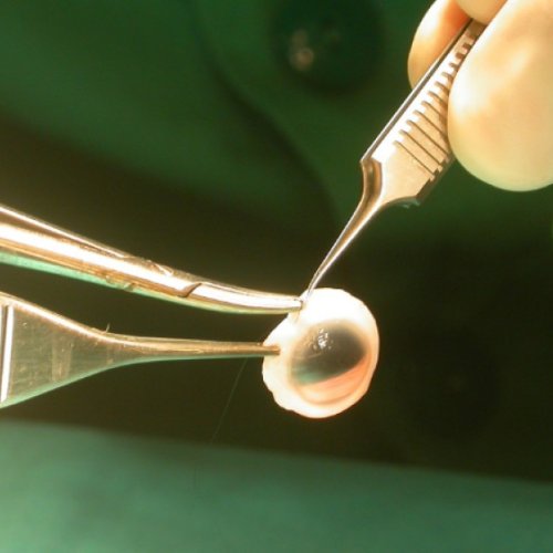 El Hospital Marcial Quiroga duplicó las donaciones para trasplante de tejidos