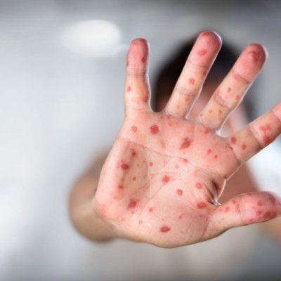 Medidas preventivas contra el sarampión