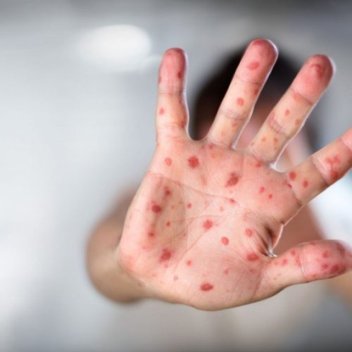 Medidas preventivas contra el sarampión