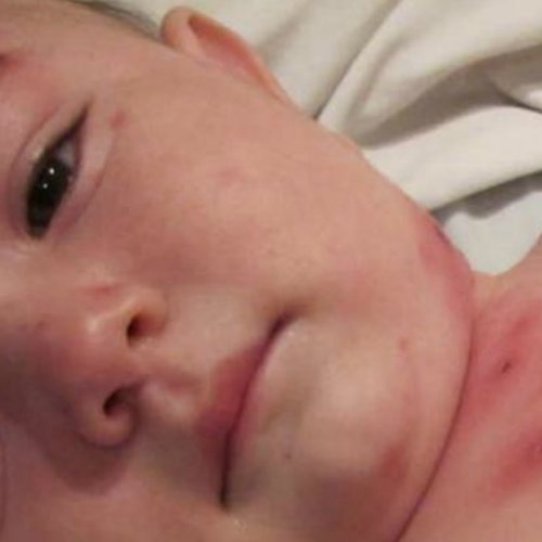 Preocupante: solo el 57% de los niños y niñas fueron vacunados contra el sarampión